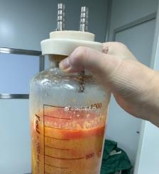 潮州水动力吸脂手术要做多久？